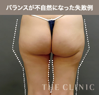 脂肪吸引後にバランスが不自然になった失敗例