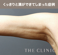 脂肪吸引後にくっきりと溝ができてしまった症例