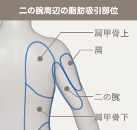 二の腕周辺の脂肪吸引部位