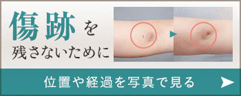 傷跡を残さないために 位置や経過を写真で見る